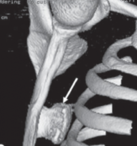 Imagem de reconstrução tomográfica em 3D da escapula mostrando a presença de um osteocondroma