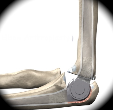 elbow_arthro_intro01