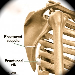 As fraturas de arcos costais e de Escápula podem ser causas de Ressalto da Escápula