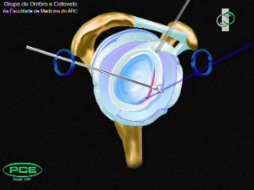 Clique aqui para ver animação da reparação de Bankart artroscópica