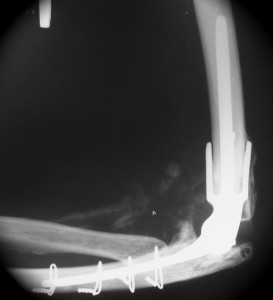 Raio-x mostrando uma revisão de prótese de cotovelo por artrose